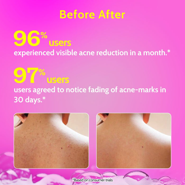 1% Salicylic Acid Body Wash with Lactic Acid | for Acne Control with Loofah - 236 ml
