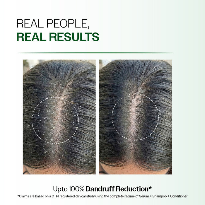 Advanced Anti-Dandruff Serum  With Defenscalp™, Salicylic Acid & Pentavitin - 50 ml