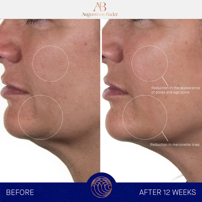 Augustinus Bader The Rich Cream before and after 12 weeks, showing smoother cheek skin