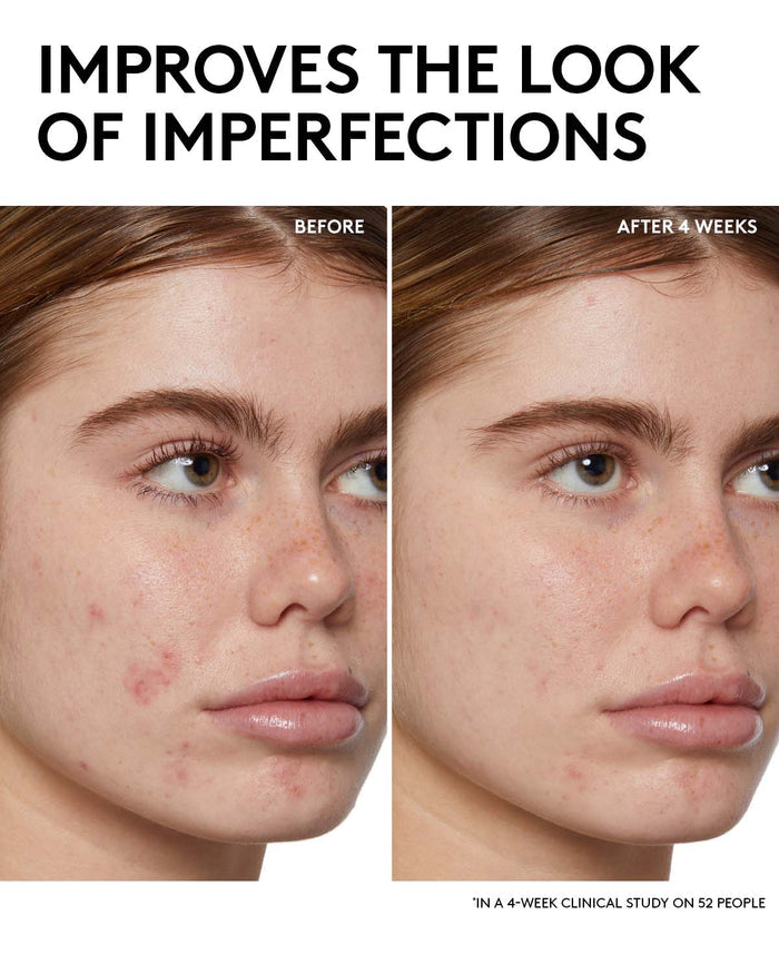 Improves skin clarity in 1 week in a 4-week clinical study on 52 people. Before and After image of model that used Cherry Dub BHA Toner with Salicylic Acid + Aloe Juice.