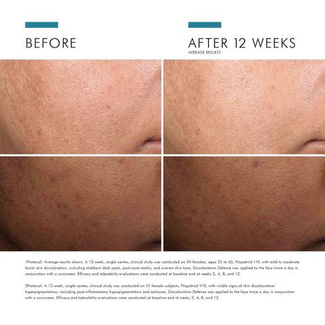 Before and after 12 weeks skin comparison showing reduced dark spots and uneven skin tone